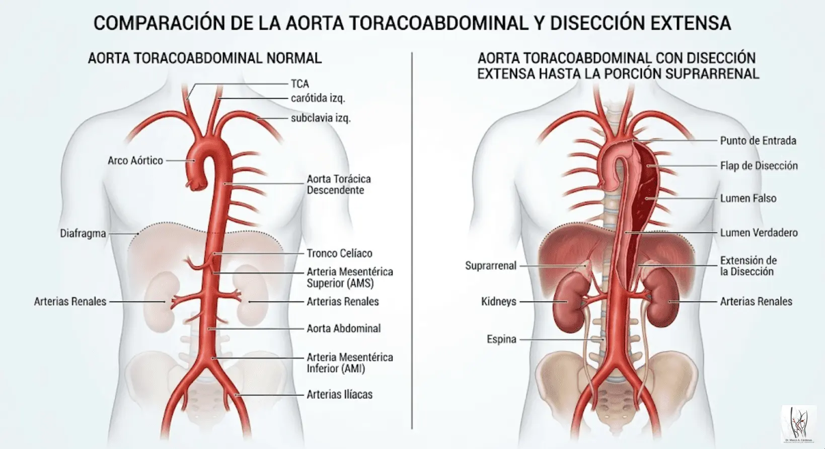 Disección Aórtica